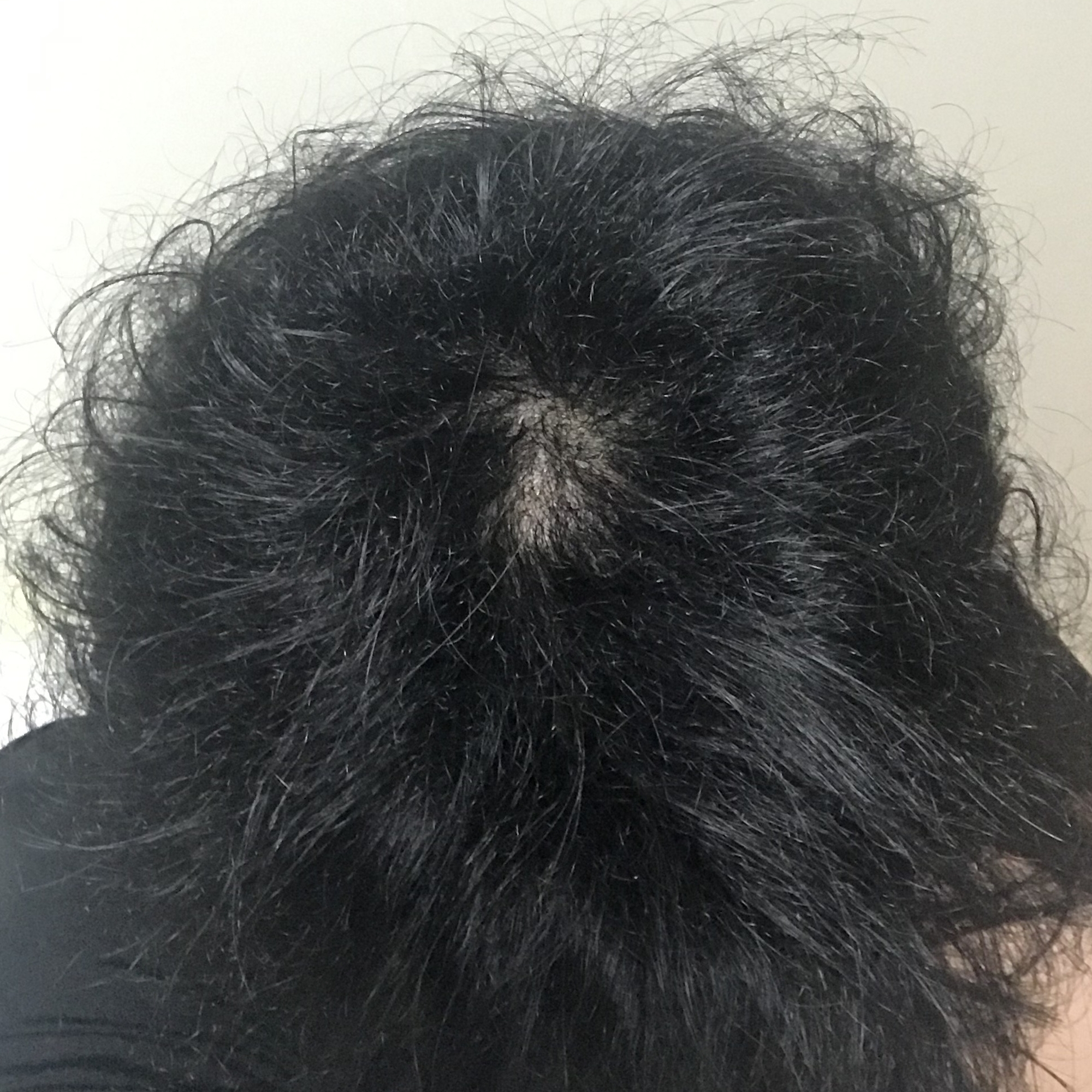  [탈모약] 커클랜드 미녹시딜 6개월 사용 후기 & 사용법