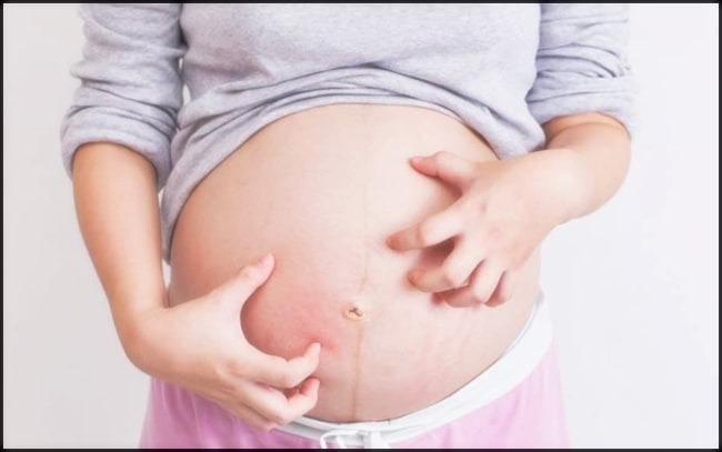 임신소양증-원인-해결방법-4
