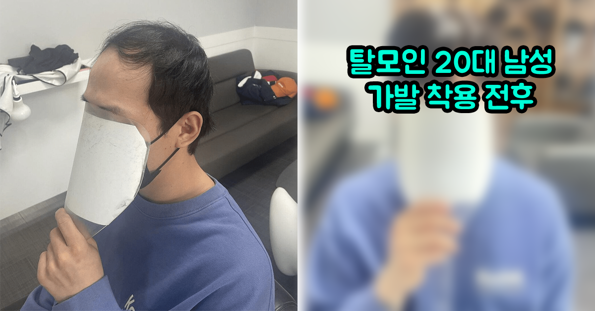  탈모인 20대 남성 가발 착용 전후