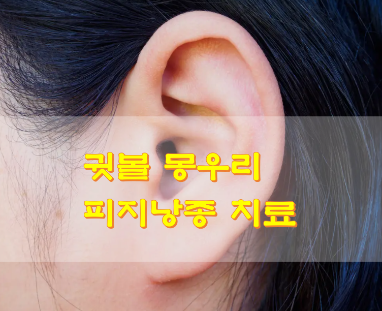  귓볼 몽우리 피지낭종 치료
