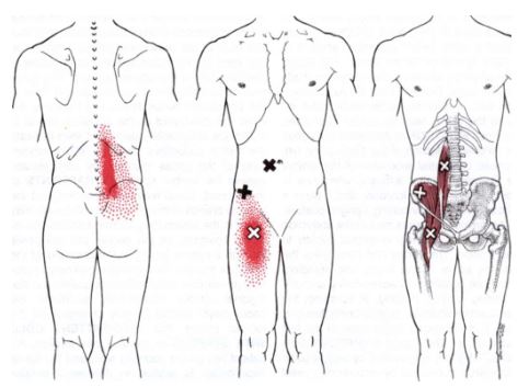 장요근의 통증유발점과 통증부위를 나타낸 그림