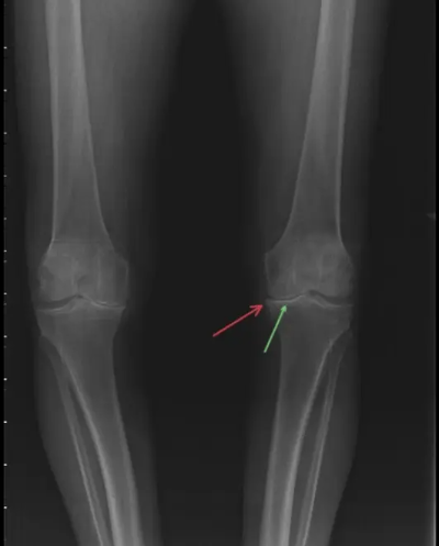 무릎 관절염의 xray