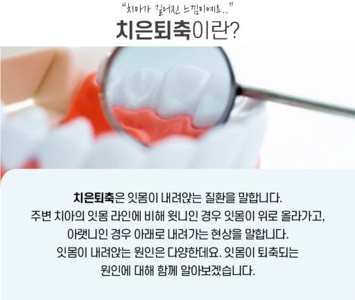 치은퇴축