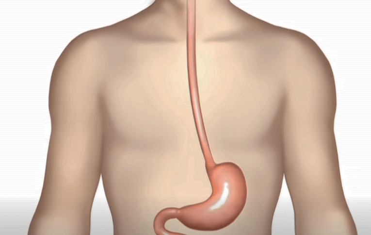  밥 먹고 소화가 안되거나 가스 혹은 더 부룩 할때, 장누수증후군 환자들  참고 사항