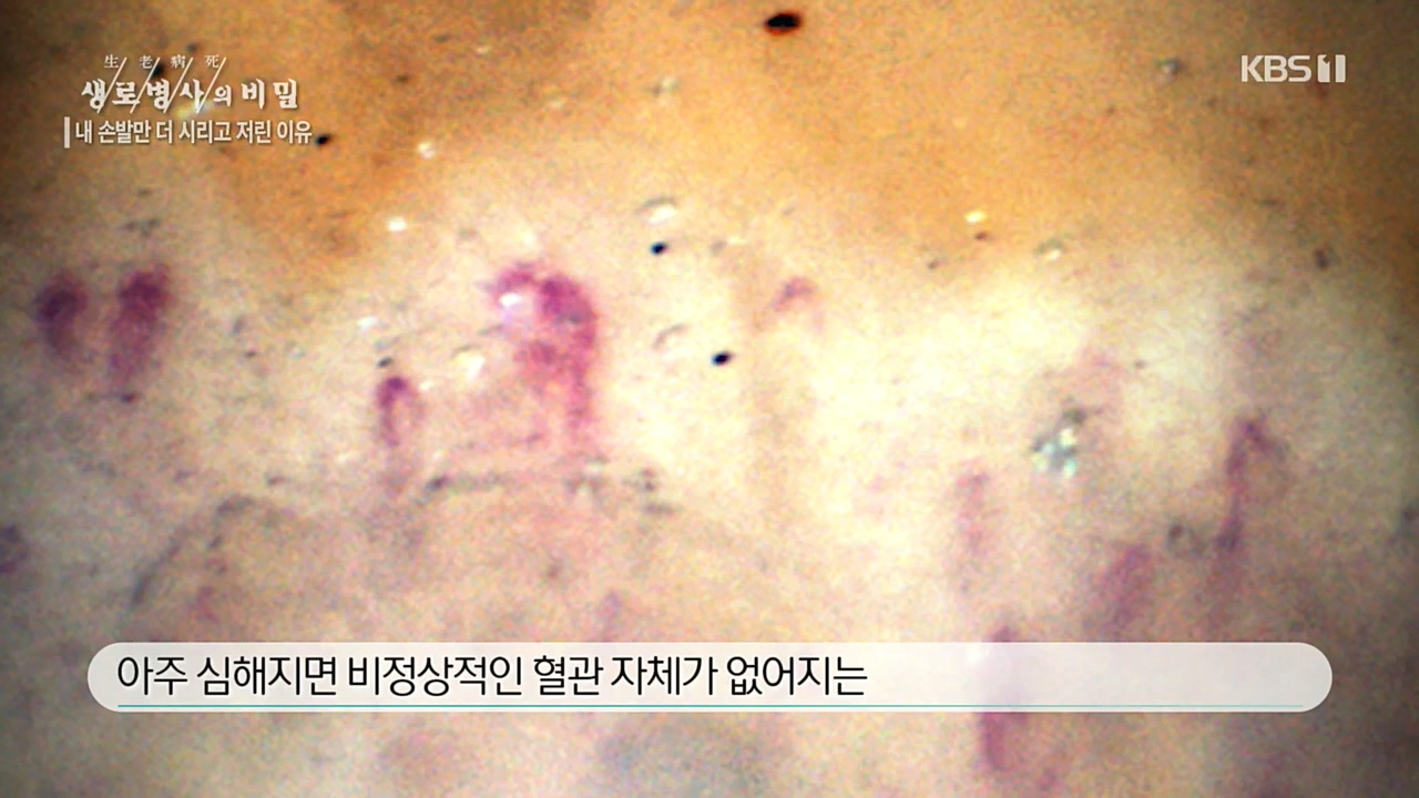 생로병사의 비밀.E847.221215p.H264-F1RST.mp4_20221215_202312.955.jpg