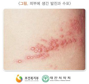  대상포진의 원인과 특징, 증상과 진단, 치료와 예방법