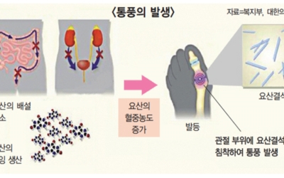 통풍 사진