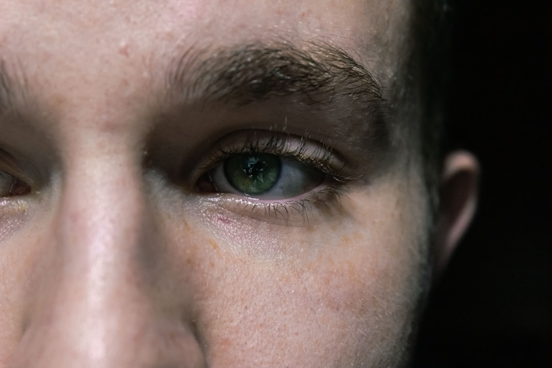 Hyperpigmentation