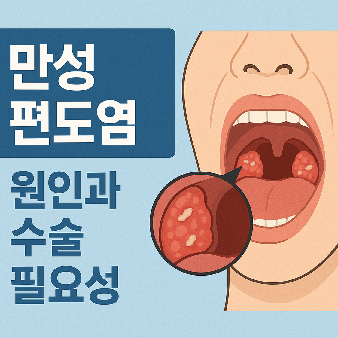 만성 편도염의 원인과 수술 필요성