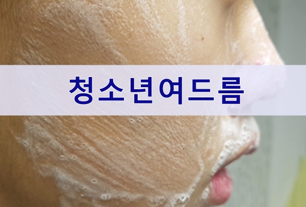  청소년남자 여드름화장품 추천, 직접 사용했어요