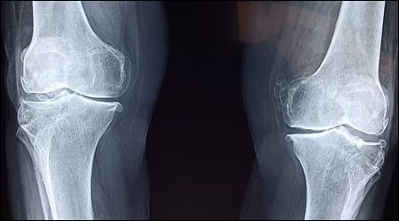다리뼈 x-ray