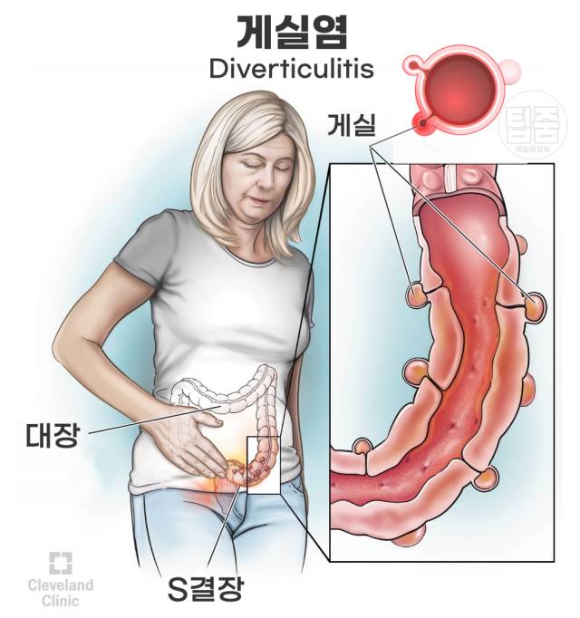 게실염의 증상 : 배가 찌르는 듯한 통증