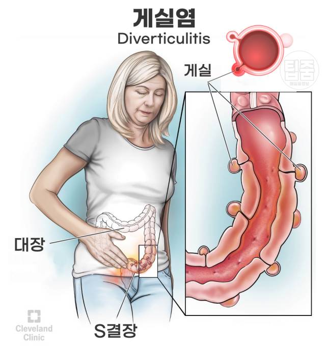 배가 찌르듯이 아픔 게실염 증상