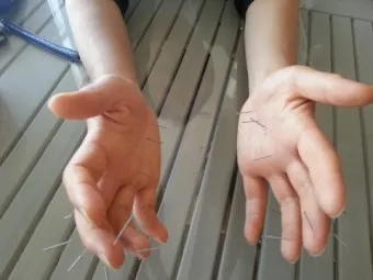 두통 수지침 편두통 혈자리_5