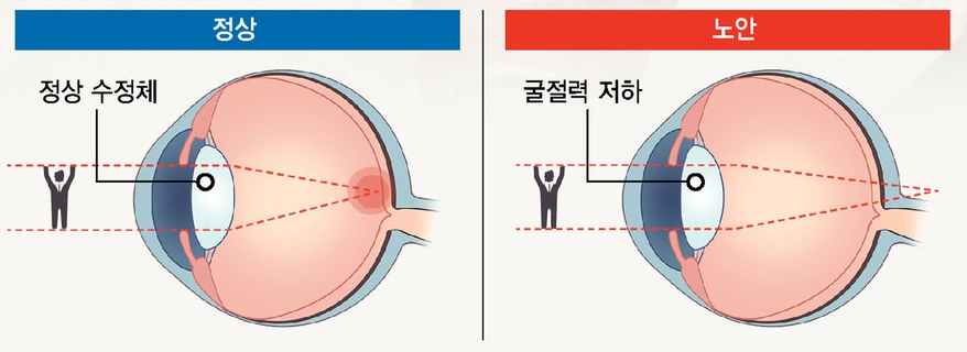 노안이란? 노안의 증상과 치료