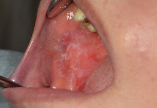 혀끝 통증, 구강작열감 증후군, 구강내과의사가 다 알려드림.