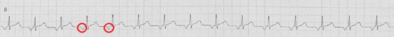 Focal atrial tachycardia ECG
