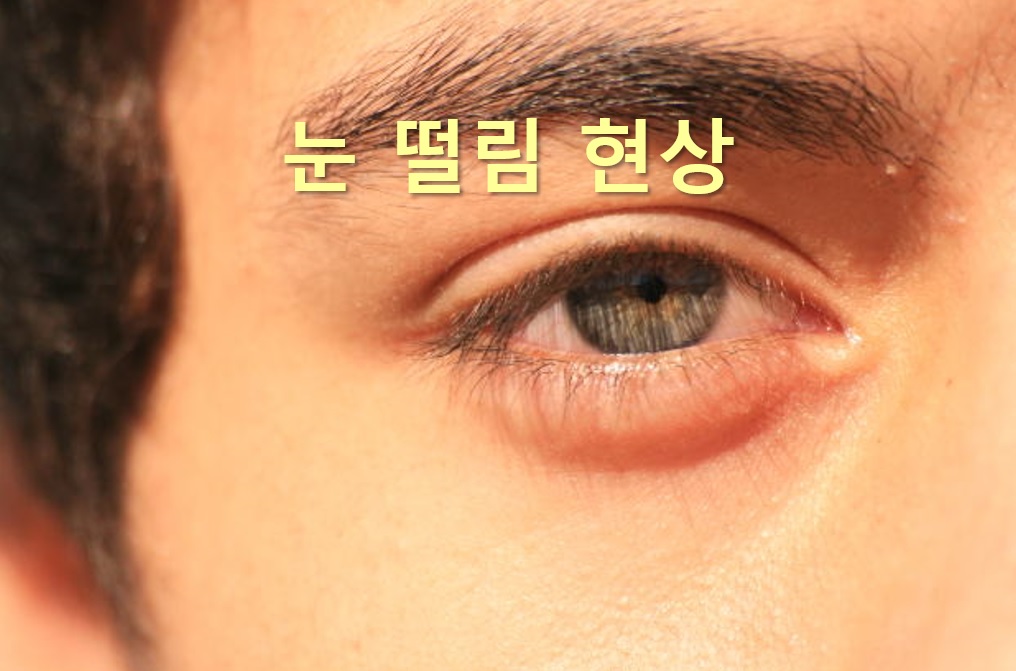  눈 떨림 현상과 눈 떨림 이유