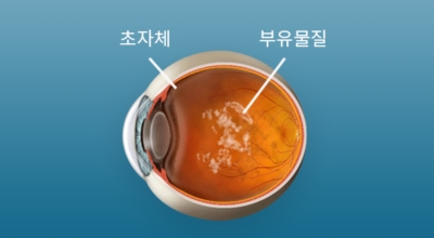  눈에 날파리 현상 & 비문증 치료방법
