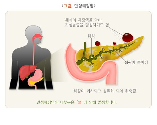 CA19-9 수치