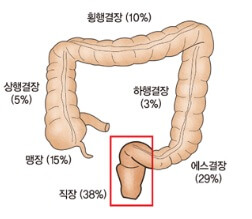 직장 부위 사진