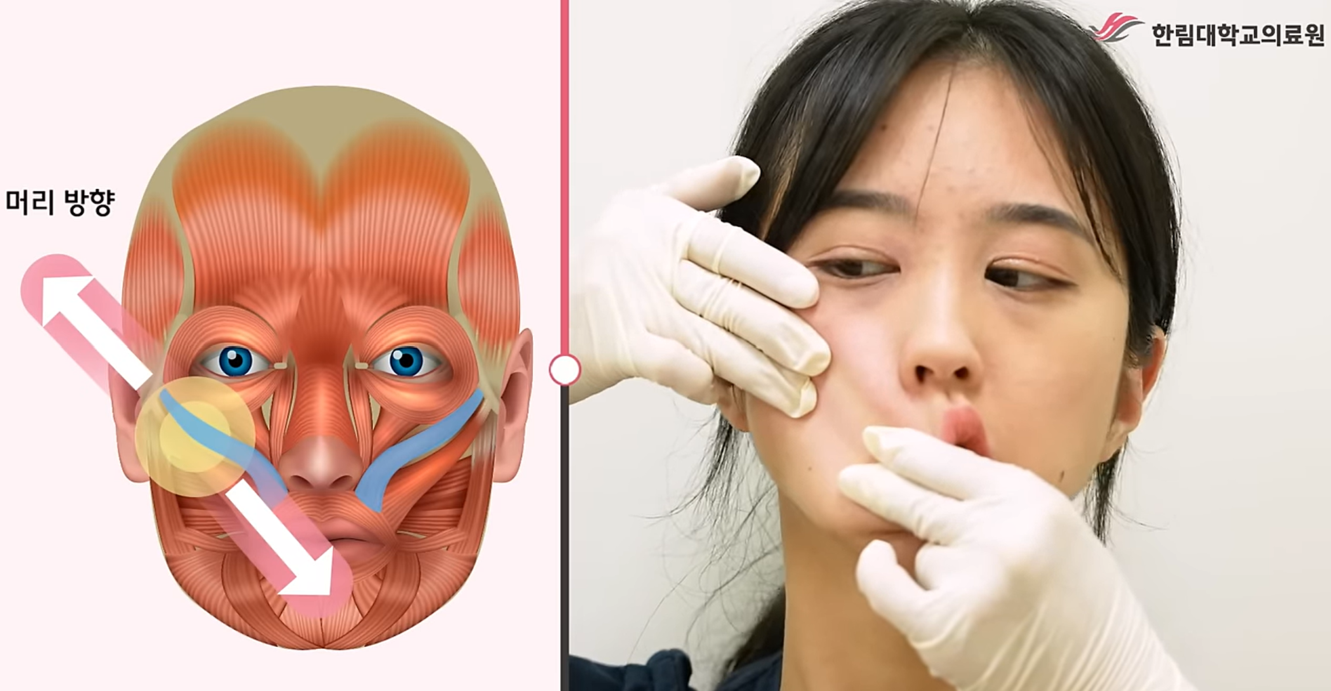 큰 광대근 스트레칭