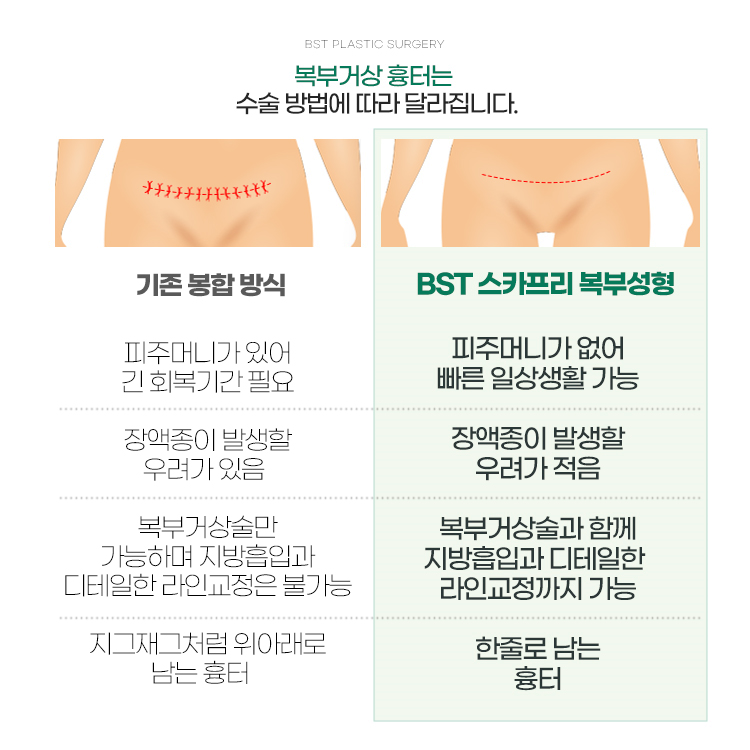 복부거상 흉터는 수술 방법에 따라서 다르게 남습니다.