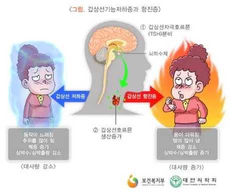 갑상샘 저하증 갑상선 기능저하증 증상 수치 치료_5