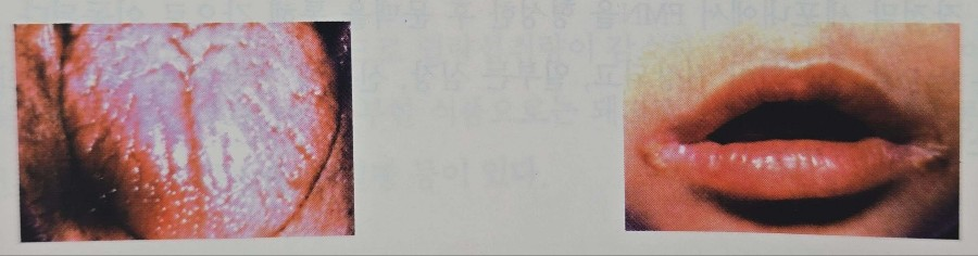 설염, 구각염