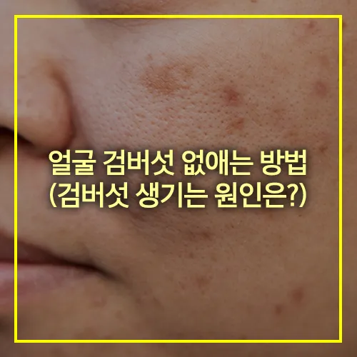 얼굴 검버섯 없애는 방법