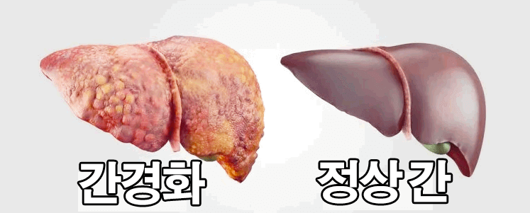  간수치 높은 이유 : 낮추는 방법