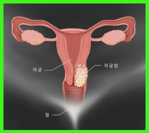 자궁 경부암 원인 증상 치료 및 예후 재발과 사망률