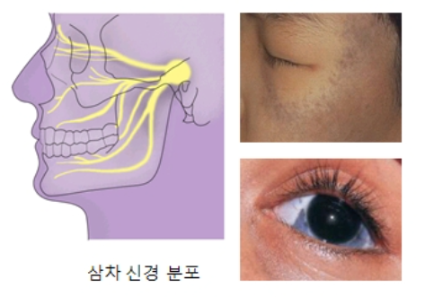 오타 모반 원인과 증상, 치료방법