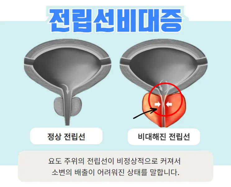 전립선비대증-요관이좁아진모습