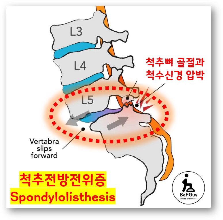 척추 전방전위증