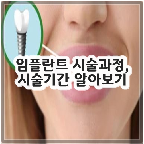 임플란트 시술과정&#44; 시술기간 알아보기