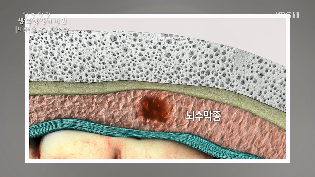 생로병사의 비밀.E870.230532p.H264-F1RST.mp4_20230605_201519.858.jpg