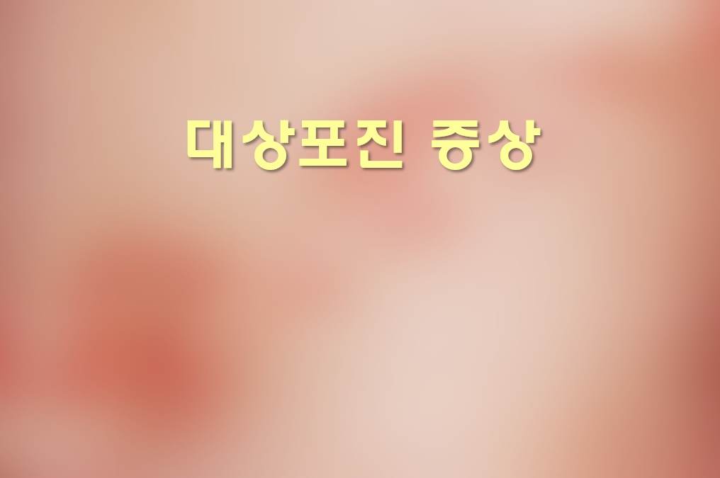  대상포진 증상과 대상포진 치료기간
