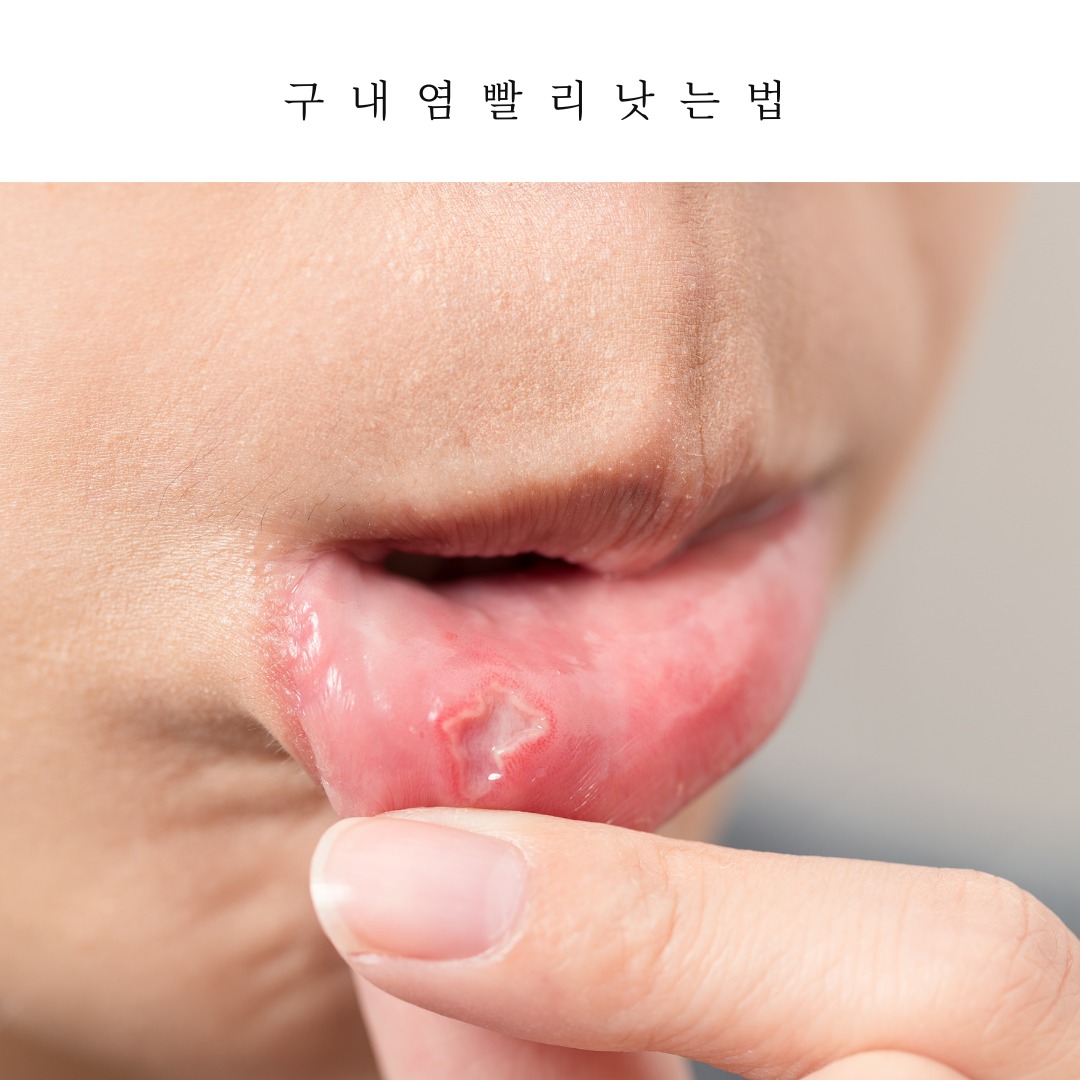 구내염-원인-증상-빨리-낫는-법