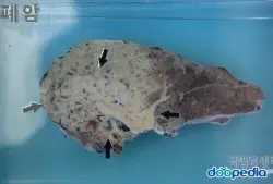 폐암
