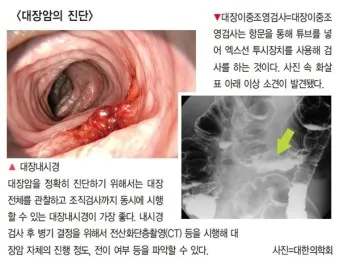 대장내시경 용종제거 후 식사 식단조절_4