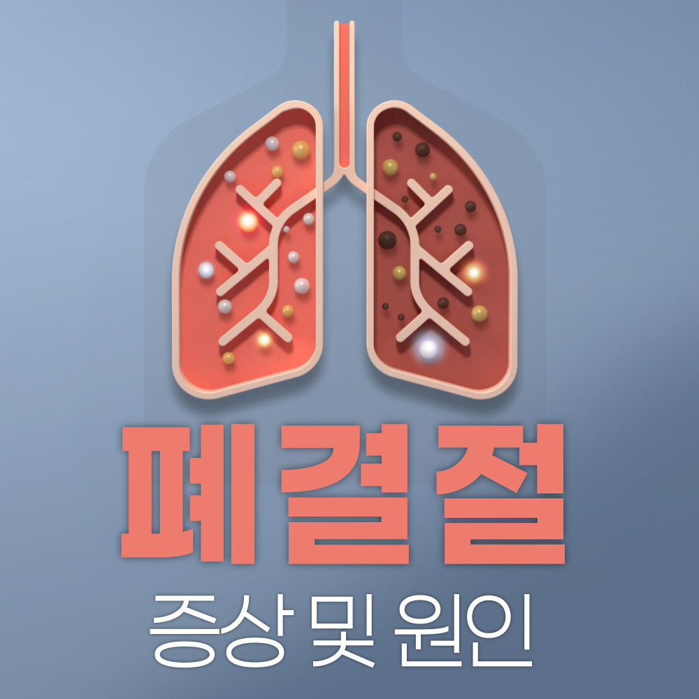 폐결절