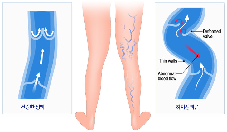 하지정맥류