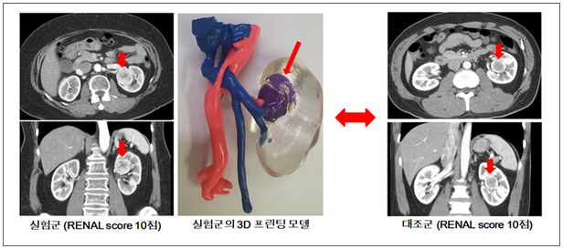신장암 초기증상 및 3기·4기 생존율, 꼭 알아야 할 신장암 검사 치료 방법