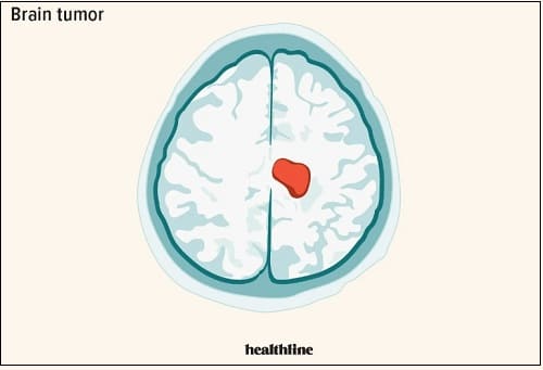 20대 아들 먼저 떠나보낸 음악평론가의 슬픔...그들을 아프게 했던 뇌종양(Brain tumor)이란