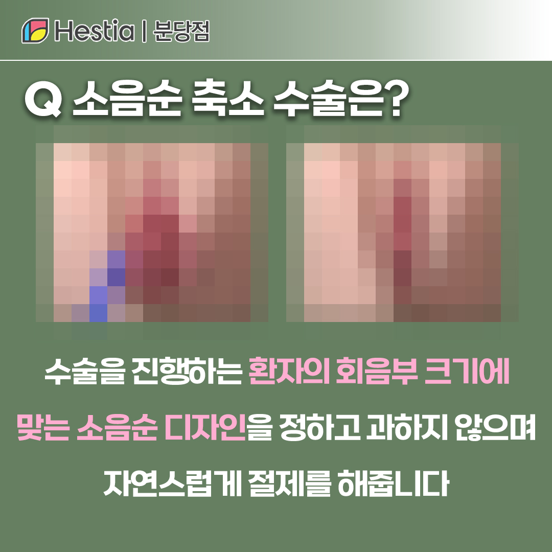 소음순 찢어짐 소음순 수술에 대해서