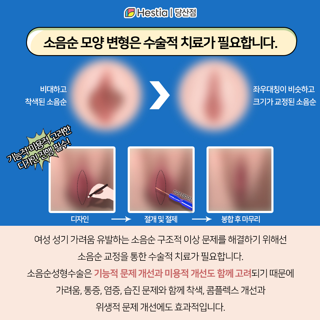 소음순 변형 치료법은?