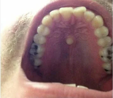 레전드 이빨 위치