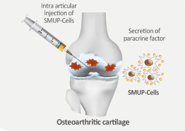 메디포스트-줄기세포-기반-치료제-SUMP-IA-01-주사-놓는위치-관절부위-치료과정