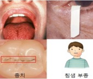 쇼그렌증후군 (출처: 서울 아산병원)